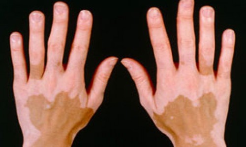 Vitiligo Surgeryy(Leucoderma)