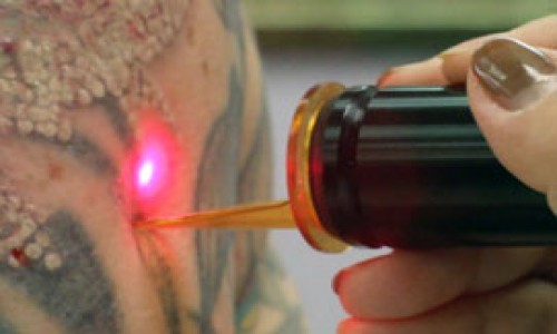 Tattoo Removal treatment