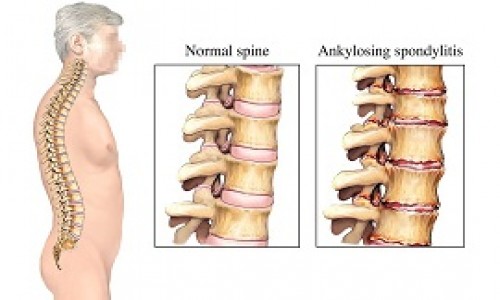 Ankylosing Spondylitis treatment