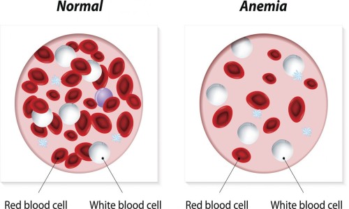 anemia (खून की कमी होना)