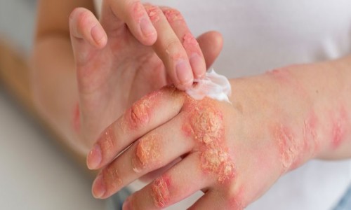 infections  (इन्फेक्शन)