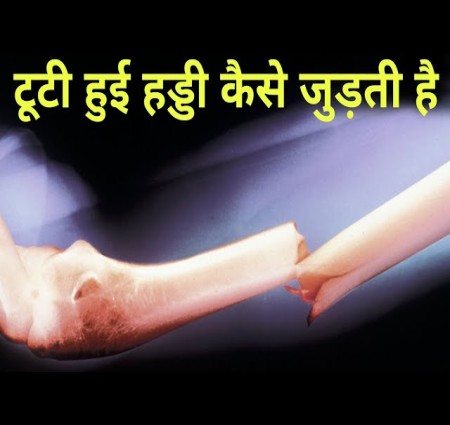 हम आज आपको मोच आना और हड्डी के टूटने के बारे में बताइए