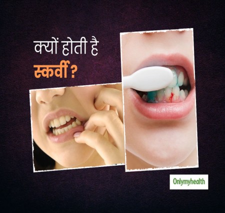 स्कर्वी रोग क्या हैक्या है